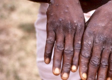 Brasileiro tem 1º caso de varíola dos macacos registrado na Alemanha