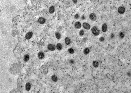 Pesquisa indica risco de monkeypox agravar infeccão por HIV