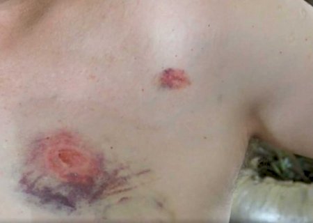 Jovem é espancada e mordida pelo marido antes de fugir de cárcere em Dourados