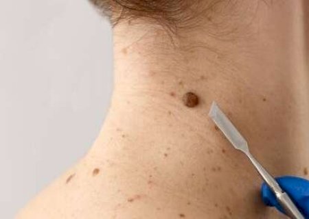 Mutir&atilde;o gratuito contra c&acirc;ncer de pele leva preven&ccedil;&atilde;o a Mato Grosso do Sul
