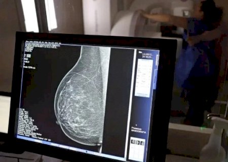 SUS incorpora teste gen&eacute;tico para c&acirc;ncer de mama que custa R$ 3 mil