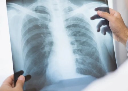 Anvisa aprova novo medicamento para câncer de pulmão avançado